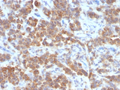 FFPE human parathyroid mass sections stained with 100 ul anti-VEGI (clone VEGI/1283) at 1:50. HIER epitope retrieval prior to staining was performed in 10mM Tris 1mM EDTA, pH 9.0.